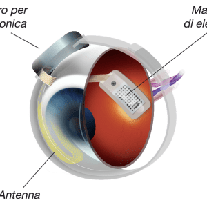 degenerazione maculare impianto