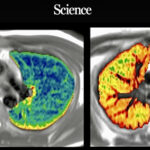 Una scansione polmonare eseguita diversi mesi dopo l’infezione da un paziente ricoverato in ospedale con COVID-19 (a destra) mostra più segni di cambiamenti infiammatori (rossi e gialli) rispetto a una scansione di una persona non infetta (a sinistra). GRUPPO COLLABORATIVO C-MORE PHOSP-COVID